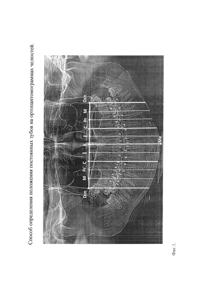 Способ определения положения постоянных зубов на ортопантомограммах челюстей (патент 2649212)