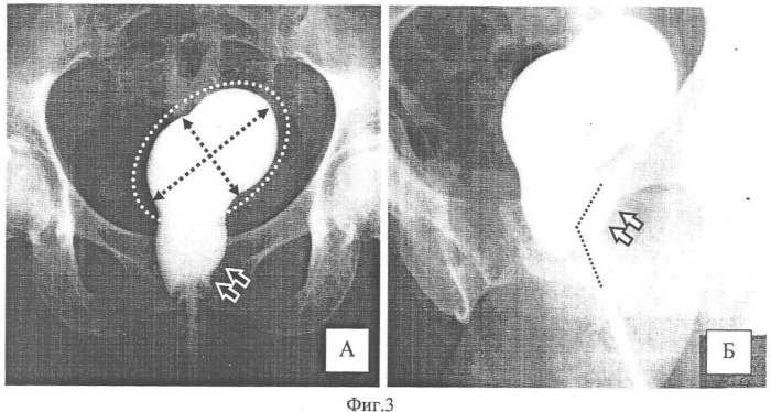 Способ лучевой диагностики тазовых органов (патент 2359613)