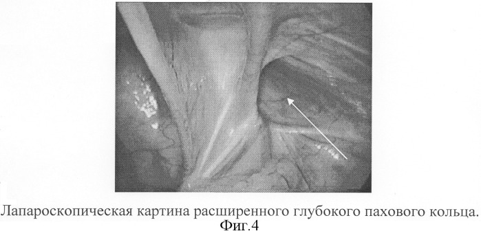 Способ определения показаний к выбору метода оперативного лечения паховых грыж у детей (патент 2303409)