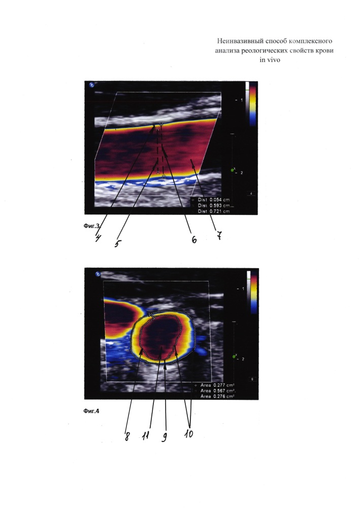 Неинвазивный способ комплексного анализа реологических свойств крови in vivo (патент 2625281)