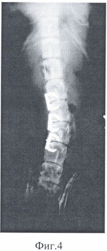 Способ формирования сколиотической деформации позвоночного столба и устройство для его осуществления (патент 2483689)