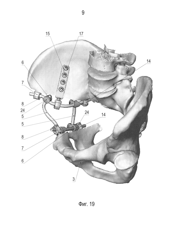 Устройство для реконструкции костей таза (патент 2626122)