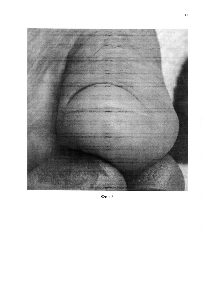 Способ восстановления ногтя (патент 2660991)