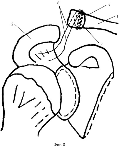 Способ замещения ключично-акромиальной связки при вывихе акромиального конца ключицы (патент 2339329)