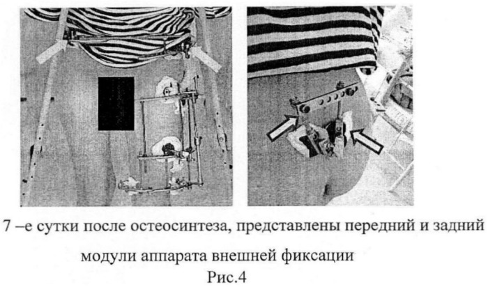 Способ чрескостного остеосинтеза односторонних нестабильных повреждений таза (патент 2457805)