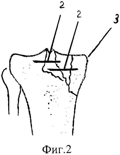 Способ лечения оскольчатых компрессионных внутрисуставных переломов метаэпифизов трубчатых костей (патент 2302213)