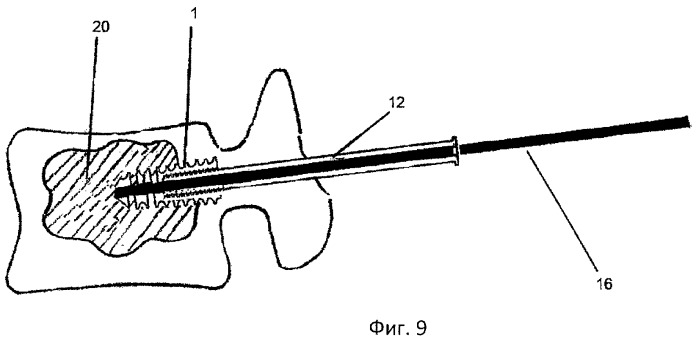 Способ хирургического лечения спинального стеноза поясничного отдела позвоночника и устройство для его осуществления (патент 2462203)