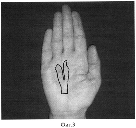 Способ идентификации границ поражения ладонного апоневроза при контрактуре дюпюитрена (патент 2553923)