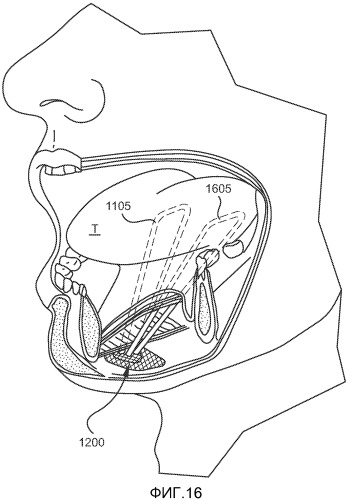 Система имплантатов и способы лечения обструктивного апноэ во сне (патент 2519960)