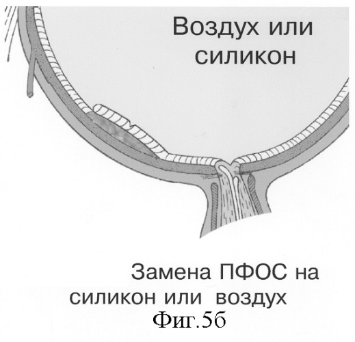 Способ хирургического удаления и фотодинамической профилактики рецидивов субретинальных неоваскулярных мембран (патент 2243748)