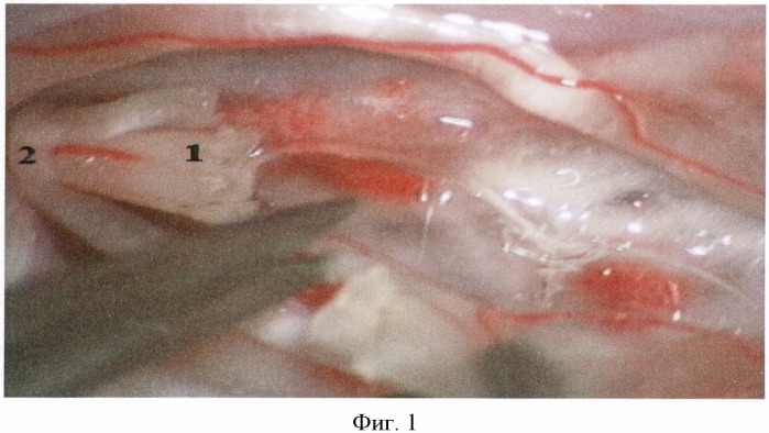 Способ хирургического лечения мышечной дистонии нижних конечностей (патент 2489110)