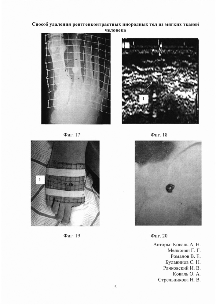Способ удаления рентгенконтрастных инородных тел из мягких тканей человека (патент 2632517)