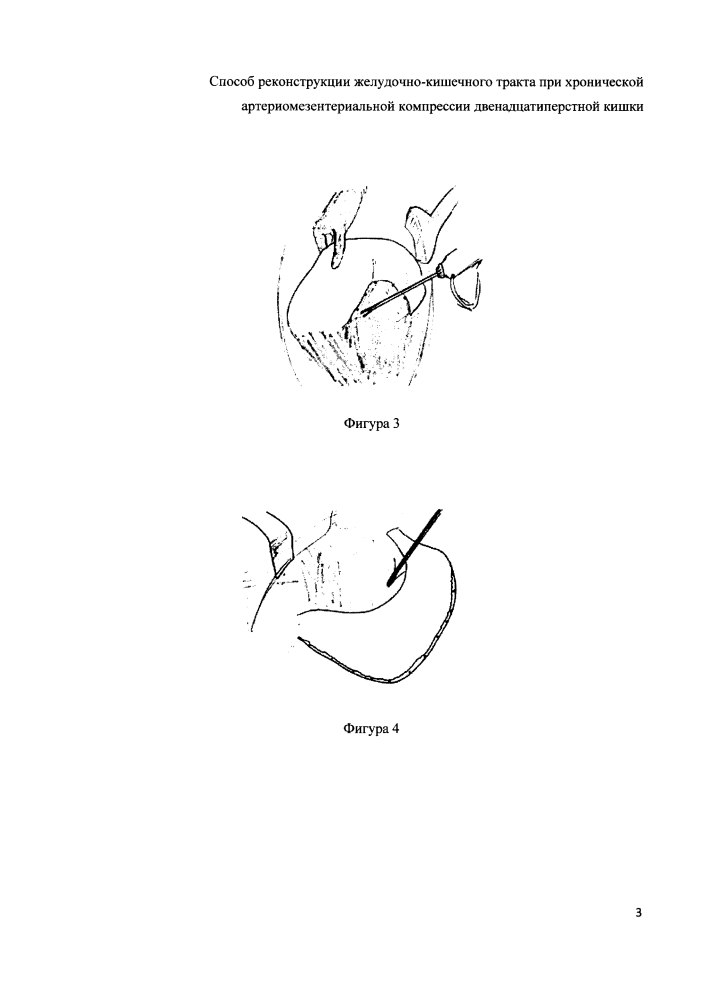 Способ реконструкции желудочно-кишечного тракта при хронической артериомезентериальной компрессии двенадцатиперстной кишки (патент 2607512)