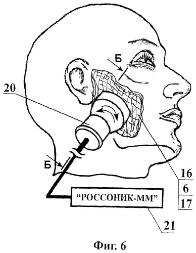 Способ лечения дистрофических заболеваний сетчатки глаза (патент 2471454)