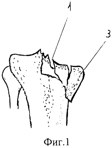 Способ лечения оскольчатых компрессионных внутрисуставных переломов метаэпифизов трубчатых костей (патент 2302213)