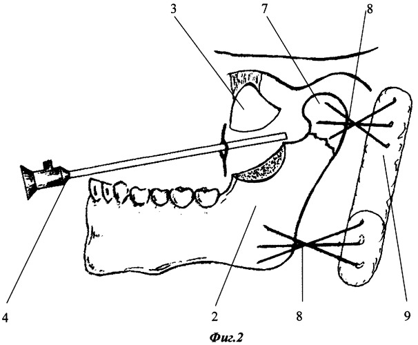 Метод внутриротового остеосинтеза под видеоэндоскопическим контролем при переломах мыщелкового отростка нижней челюсти с вывихом головки в подвисочную ямку (патент 2311143)