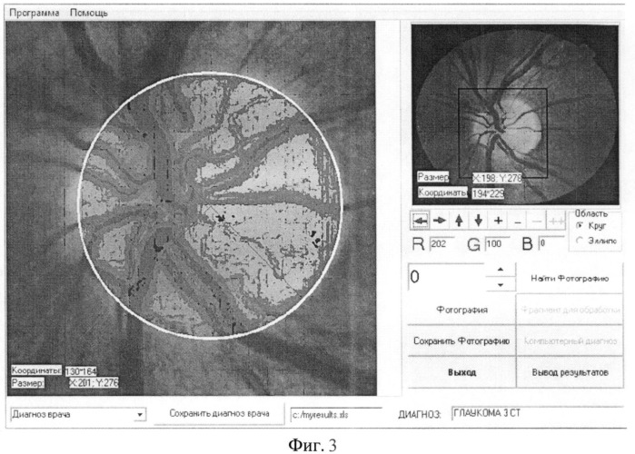 Способ диагностики патологии зрительного нерва (патент 2496404)