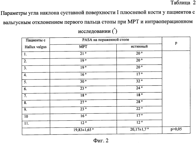 Способ определения наклона суставной поверхности головки первой плюсневой кости стопы (патент 2567825)