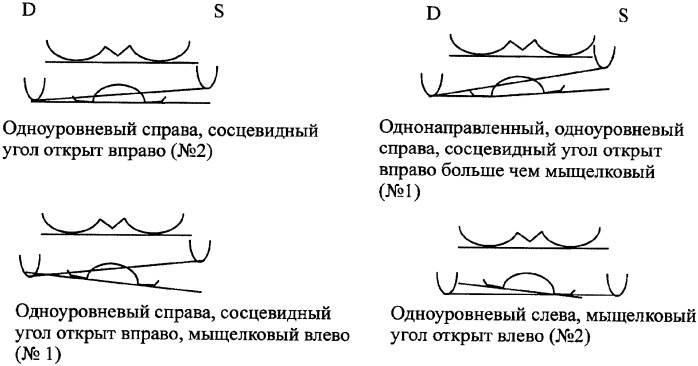 Способ определения асимметрии основания черепа (патент 2353294)