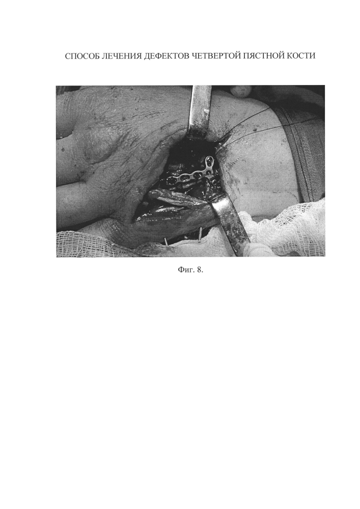 Способ лечения дефектов четвертой пястной кости (патент 2601856)
