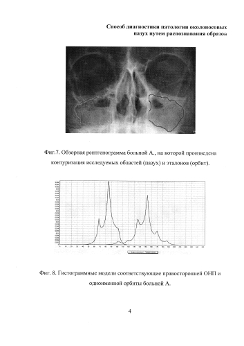 Способ диагностики патологии околоносовых пазух путем распознавания образов (патент 2585700)