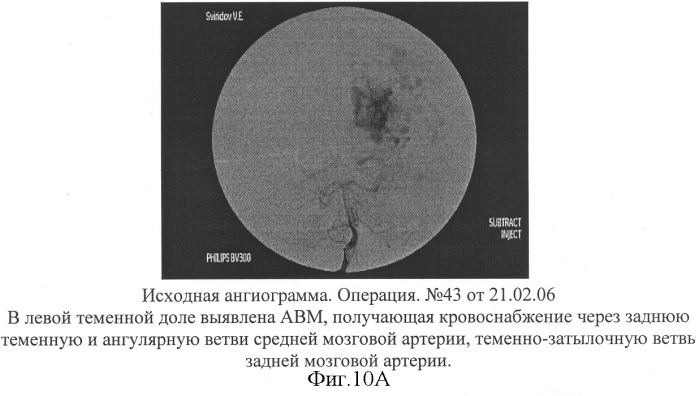 Способ эмболизации артериовенозных мальформаций головного мозга в условиях общей анестезии и управляемой гипотонии (патент 2315634)