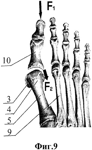 Способ хирургического артропластического лечения вальгусной деформации первого пальца стопы (патент 2563064)