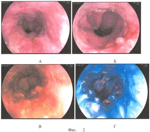 Способ комбинированной хромоскопии пищевода (патент 2408251)