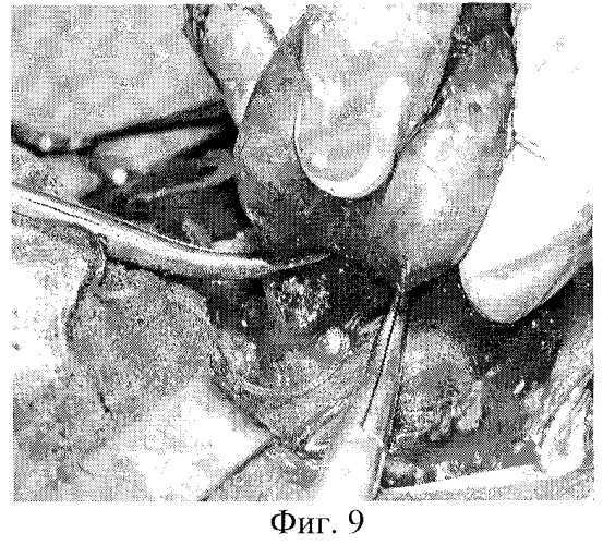 Способ хирургического лечения диффузного токсического зоба (патент 2281040)