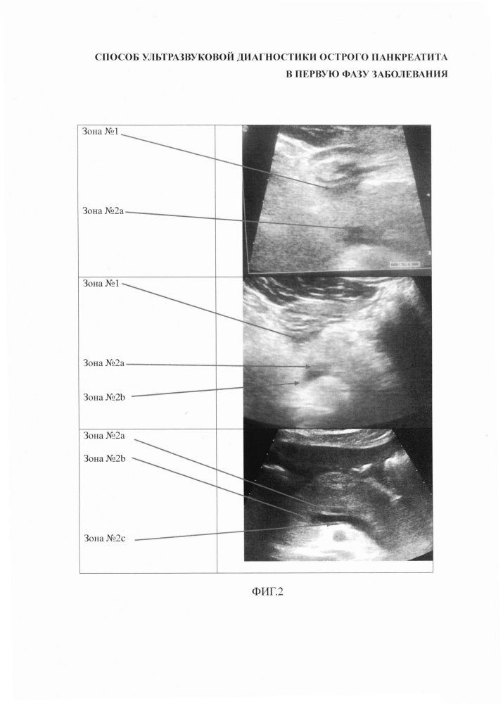 Способ ультразвуковой диагностики острого панкреатита в первую фазу заболевания (патент 2622611)