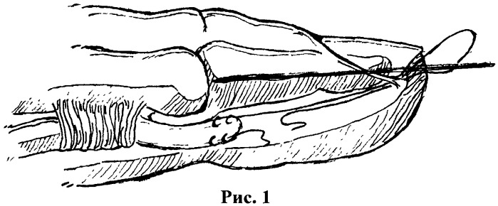 Способ лечения повреждения сухожилия глубокого сгибателя пальца кисти в i зоне (патент 2458650)