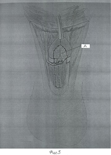 Способ хирургического лечения гипоспадии (патент 2371103)