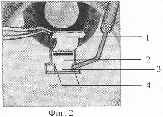 Способ хирургического лечения открытоугольной глаукомы (патент 2308917)