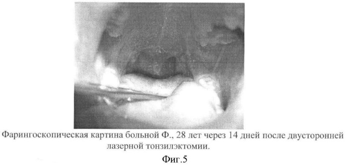 Способ лазерной двусторонней тонзиллэктомии (патент 2364369)