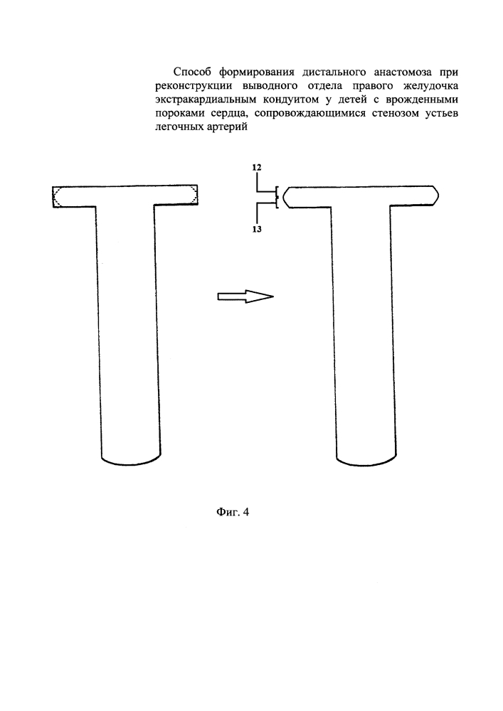 Способ формирования дистального анастомоза при реконструкции выводного отдела правого желудочка экстракардиальным кондуитом у детей с врожденными пороками сердца, сопровождающимися стенозом устьев легочных артерий (патент 2639030)