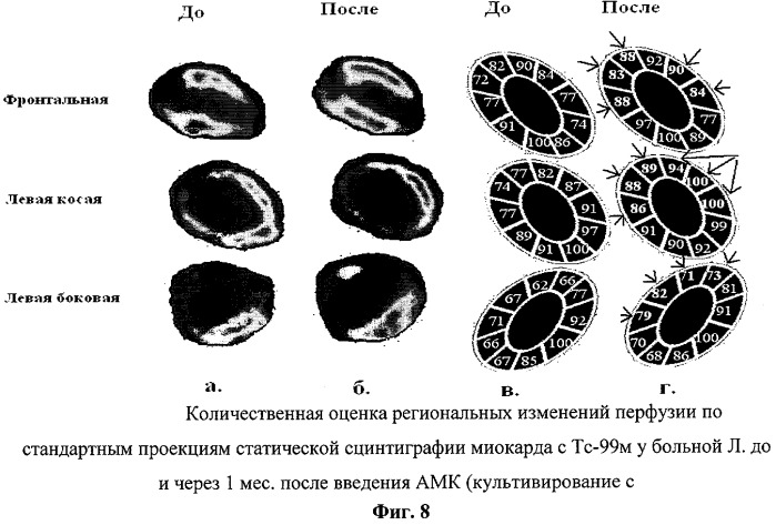 Способ лечения хронических заболеваний (варианты), способ получения биотрансплантата (варианты), биотрансплантат (варианты) (патент 2322248)