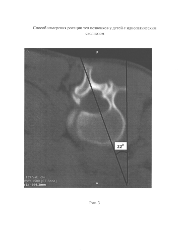 Способ измерения ротации тел позвонков у детей с идиопатическим сколиозом (патент 2587035)
