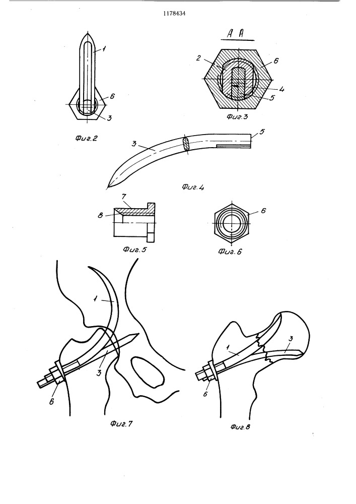 Устройство для остеосинтеза (патент 1178434)