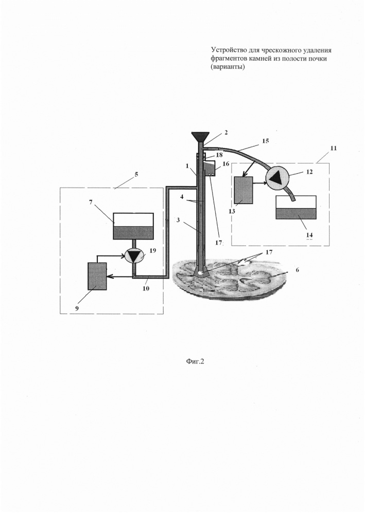 Устройство для чрескожного удаления фрагментов камней из полости почки (варианты) (патент 2637820)