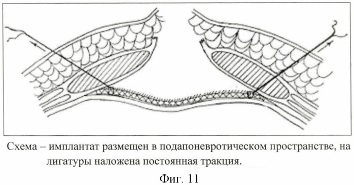 Способ размещения имплантата (патент 2445011)