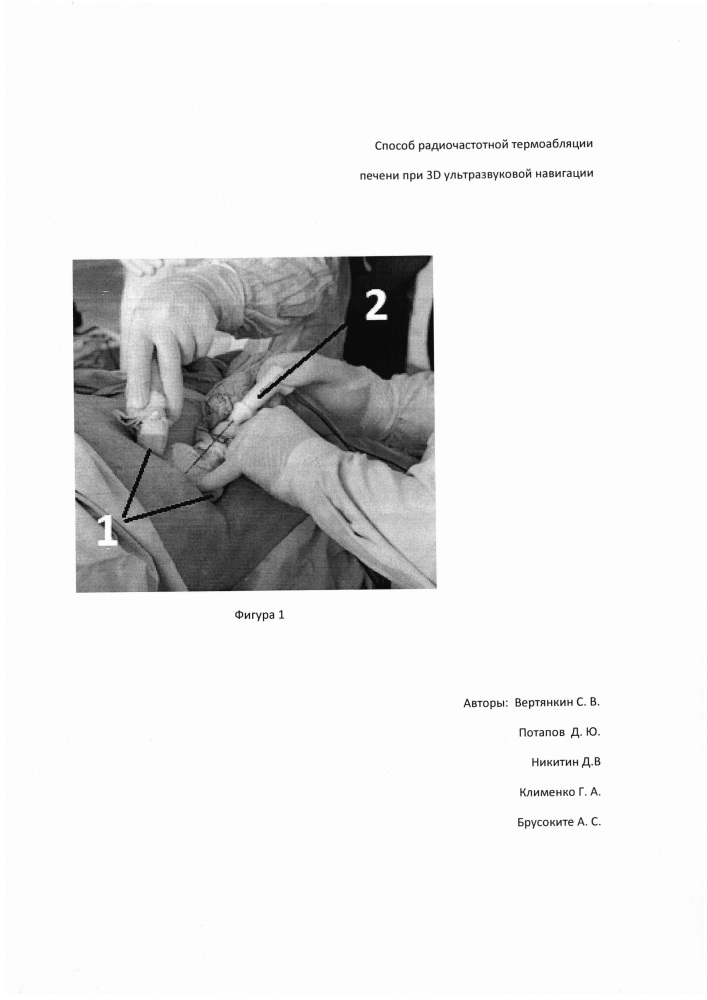 Способ радиочастотной термоабляции опухолевого новообразования печени (патент 2654267)