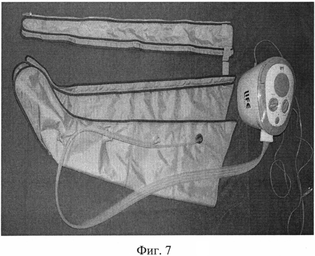 Способ лечения вторичных лимфедем нижних конечностей ii-iii стадии (патент 2570612)