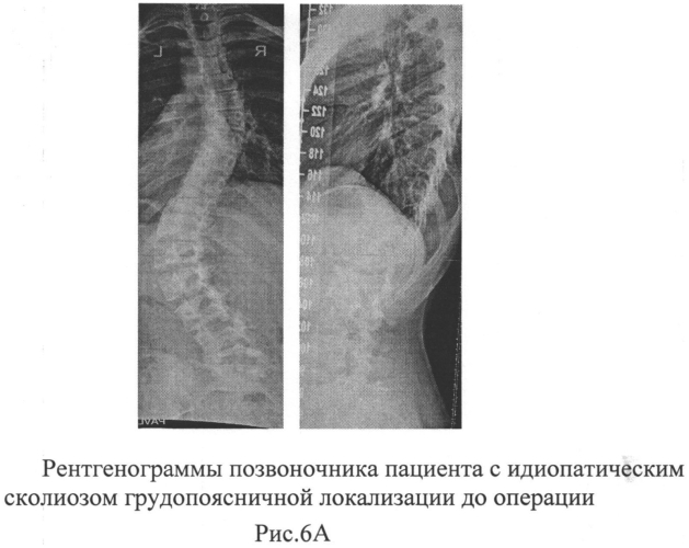 Способ коррекции идиопатического сколиоза позвоночника грудопоясничной локализации у детей (патент 2562511)