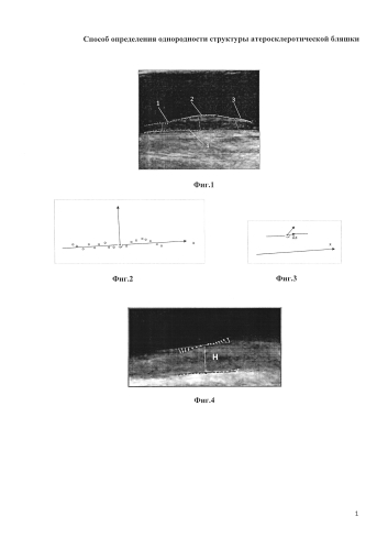 Способ определения однородности структуры атеросклеротической бляшки (патент 2584135)
