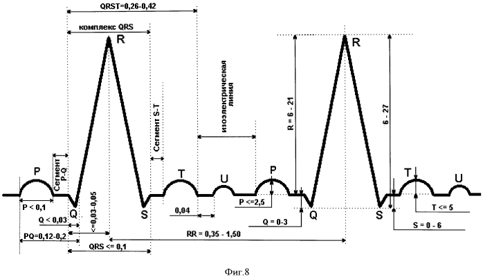 Способ экспресс-оценки электрической стабильности сердца (патент 2567271)