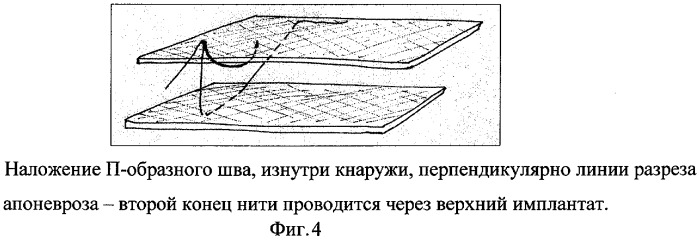 Способ ушивания апоневроза (патент 2277384)