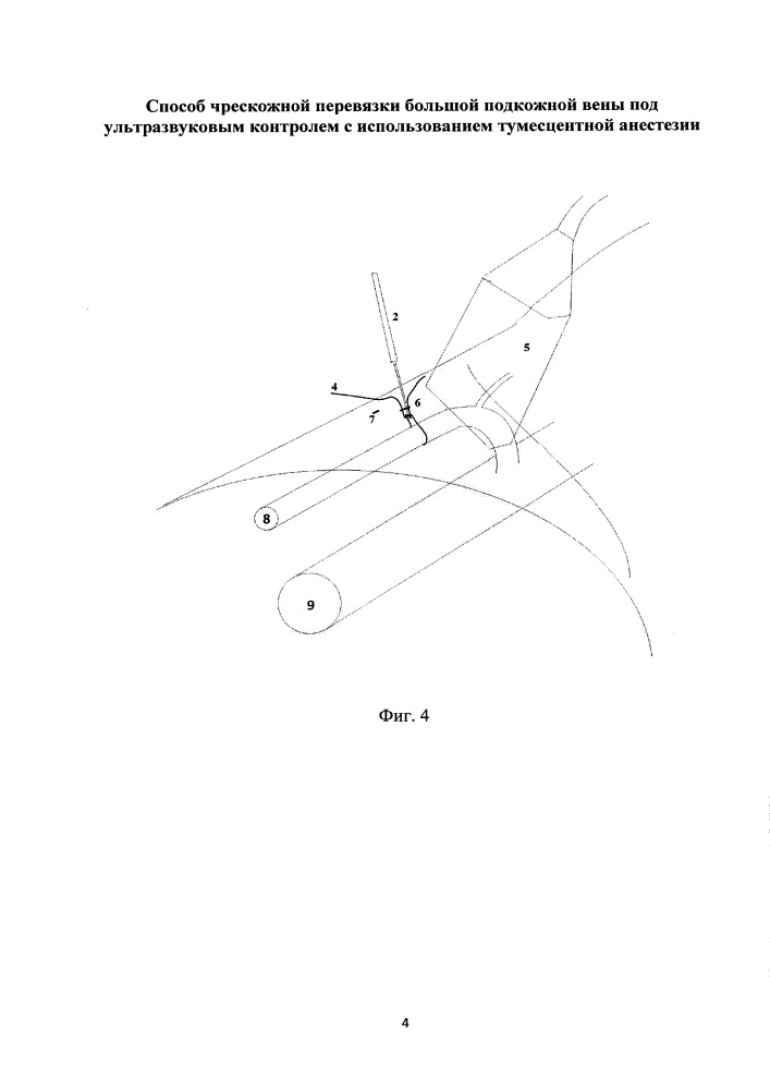 Способ чрескожной перевязки большой подкожной вены под ультразвуковым контролем с использованием тумесцентной анестезии (патент 2651081)