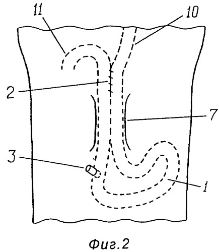 Способ образования временно изолируемой кишечной петли (патент 2274905)