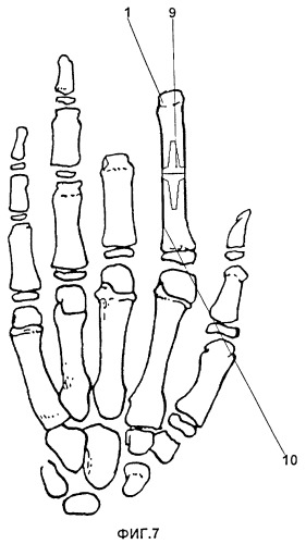 Способ эндопротезирования культей пальцев кисти (патент 2410049)