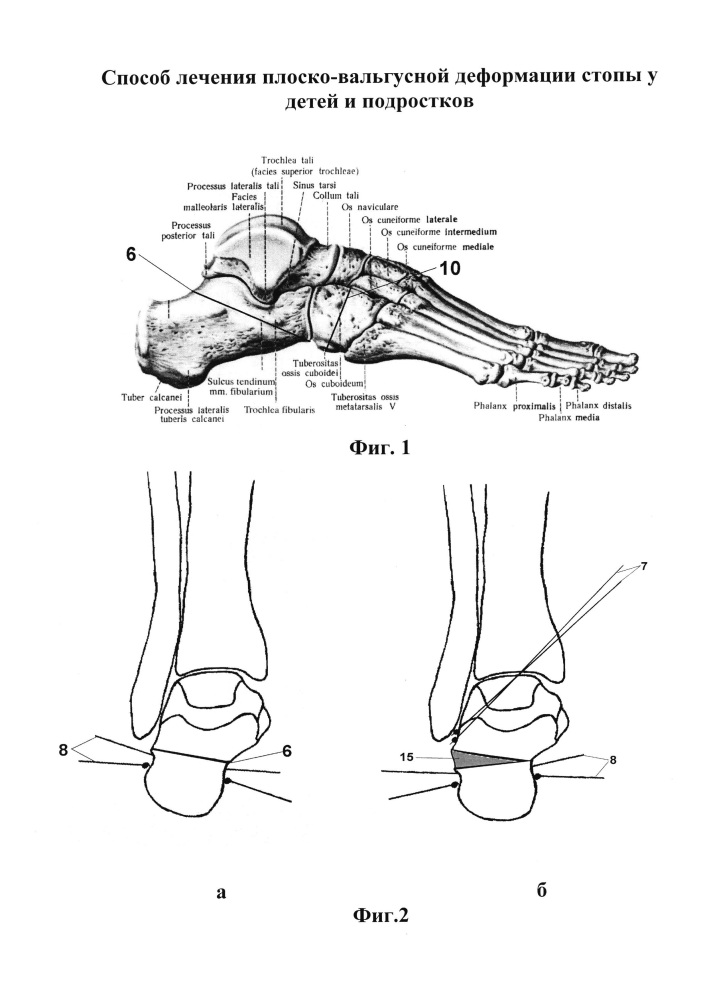Способ лечения плоско-вальгусной деформации стопы у детей и подростков (патент 2612097)